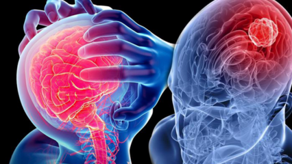 Vad är degeneration av ryggmärg (ryggmärg)? Vilka är symtomen på cerebellum (ryggmärgen)?