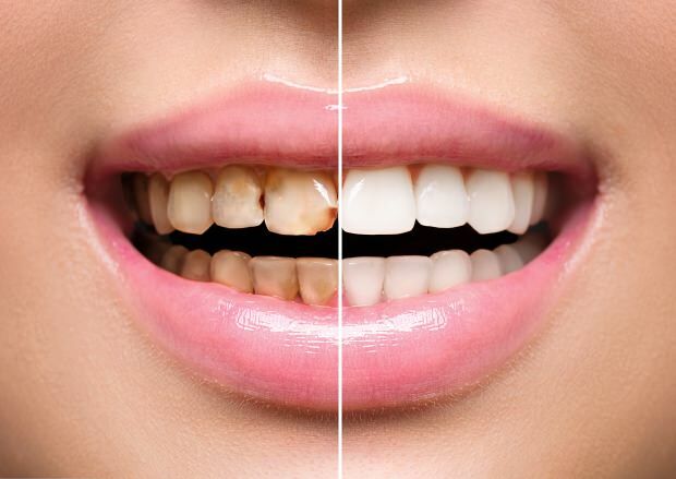 Som ett resultat av ohälsosam näring uppstår både tandfärgning och tandförlust
