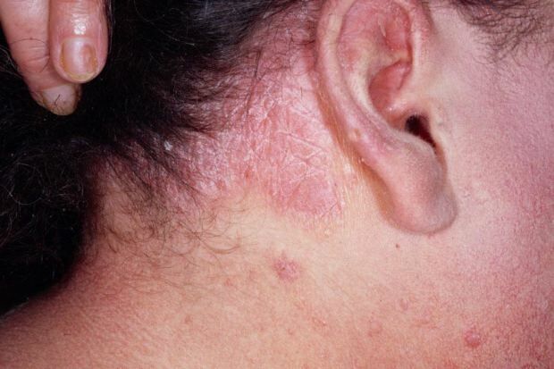 Vilka är symtomen på seborrheic dermatit och vem visas det? Livsmedel som utlöser sjukdomen