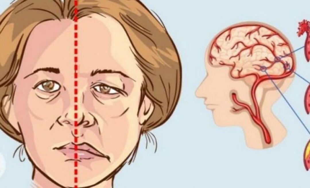 Vad är en stroke? Vilka är symptomen på stroke? Hur förhindrar man stroke?