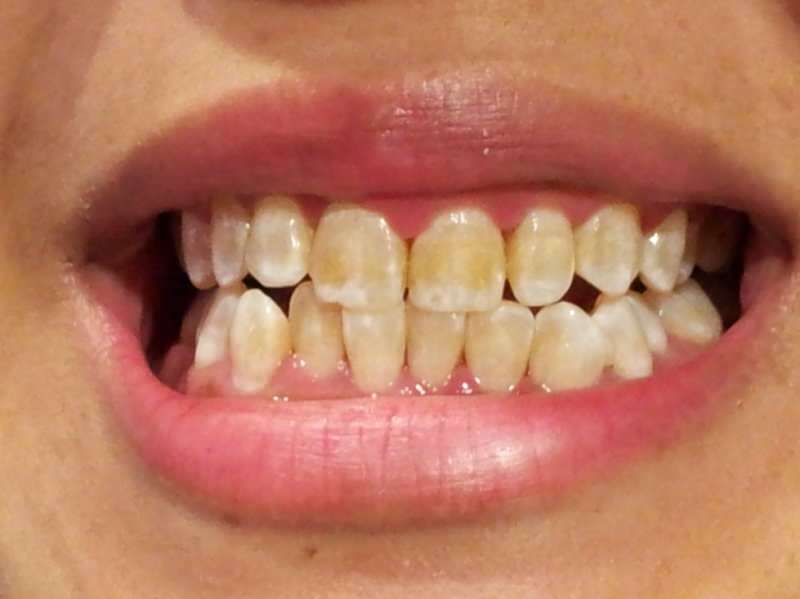 tandbild av en person vars tänder börjar bli mörkare