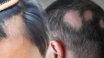 Vad är ringorm (Alopecia areata)? Vad är ringormsymtom? Effektiva lösningar för ringorm