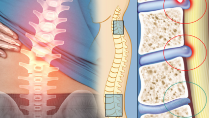 Vad är ryggmärgsminskning? Vilka är symptomen på ryggmärgsminskning? Finns det ett botemedel mot ryggmärgsminskning?