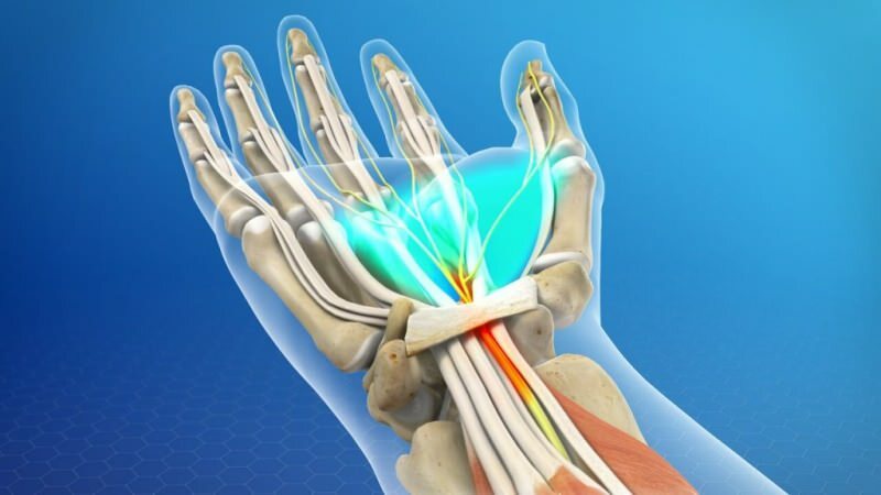 till följd av tryck skadas muskelsystemet i handleden vilket orsakar karpaltunnelsyndrom
