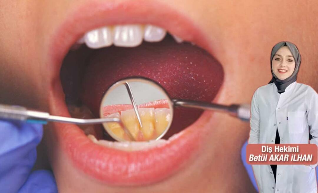 Vad ska man göra för att undvika tandsten? Vilka är fördelarna med tandavskalning?