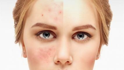 De mest effektiva och bästa acne-krämerna på apoteket 2021