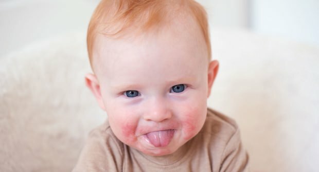 Uppmärksamhet hos spädbarn med röda kinder! Slapped kind syndrom och dess symtom