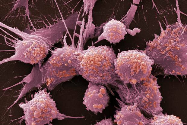 Vad är cancer och vilka är dess symtom? Hur många typer av cancer finns det? Hur förhindras cancer?